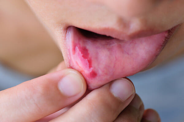 choroba jamy ustnej